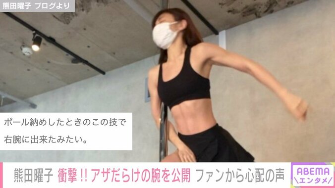 熊田曜子、ポールダンスの練習で右腕を負傷 アザだらけの衝撃写真に「早く消えますように」「体は大切に」と心配の声 1枚目