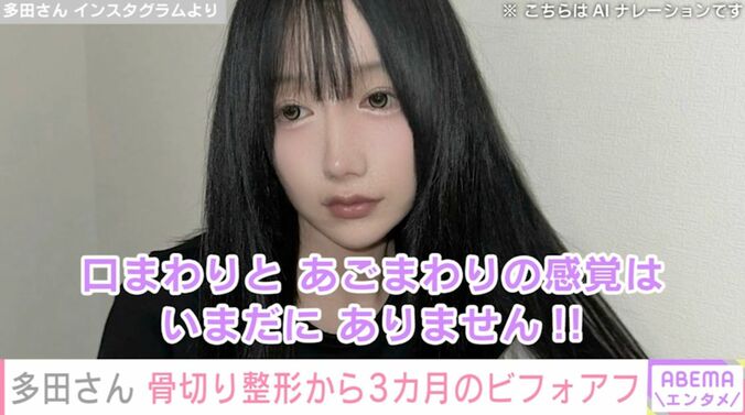 【写真・画像】『月曜から夜ふかし』フェフ姉さんの友人・多田さん、両あご&輪郭骨切り整形から3カ月後のビフォーアフターを公開「感覚はいまだにありません」　1枚目