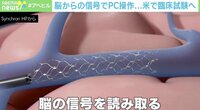 【映像】脳の“信号”でパソコンを操作 専用「ステント」が脳に入る様子