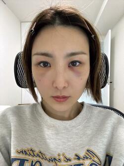  はあちゅう氏、整形手術のダウンタイム中の自撮りショットを公開「痛そう」「参考になります」の声 