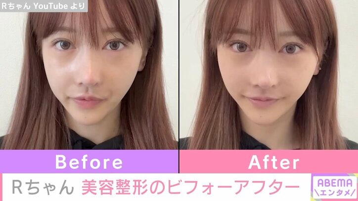 “整形総額約2000万円”Rちゃん「実は整形してたんだけど気づいた？」新たな施術のビフォーアフターを公開