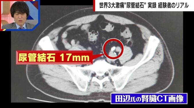 尿管結石の人のCT画像