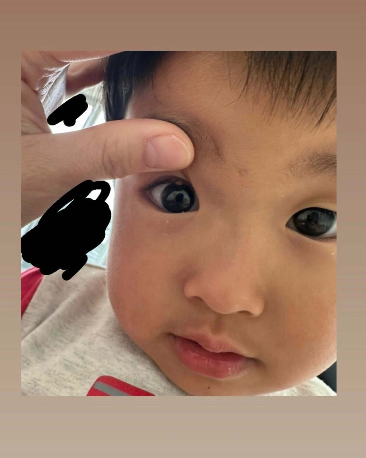 目の下 腫れ 子供
