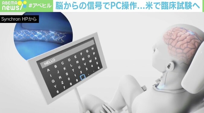 脳の信号でPC操作 米の臨床実験に専門家「ゼロが1になる」「ALS患者にとって大きな一歩だ」 2枚目