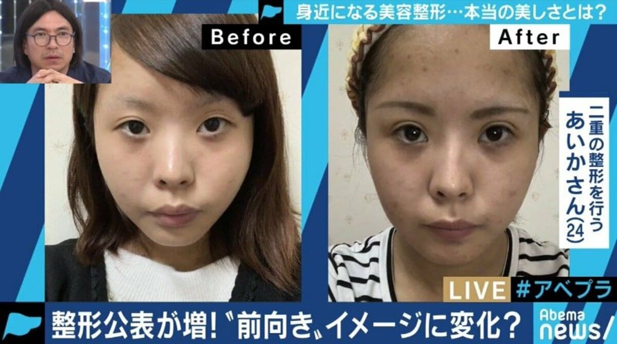 整形手術のイメージが変化 希望者が増加中 専門家 ゴールは美しい自分ではなく 明るい自分 国内 Abema Times