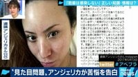 AbemaPrime - 企画 - 見た目が原因で恋愛にも障壁 原因不明の皮膚の病気 “乾癬”の症状とは (18/10/08) | 動画視聴は【Abemaビデオ(AbemaTV)】