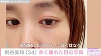 桐谷美玲、赤く腫れた目の写真を公開