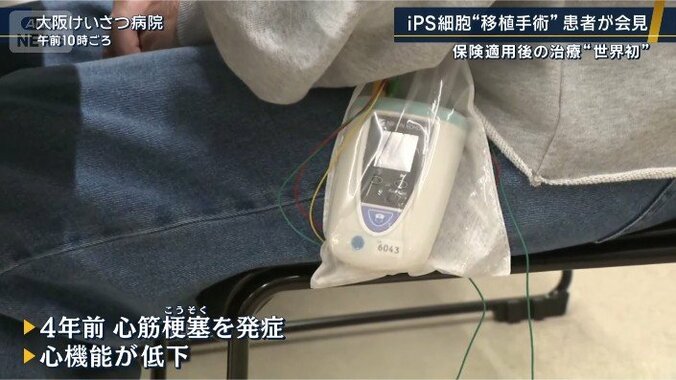 4年前に心筋梗塞を発症