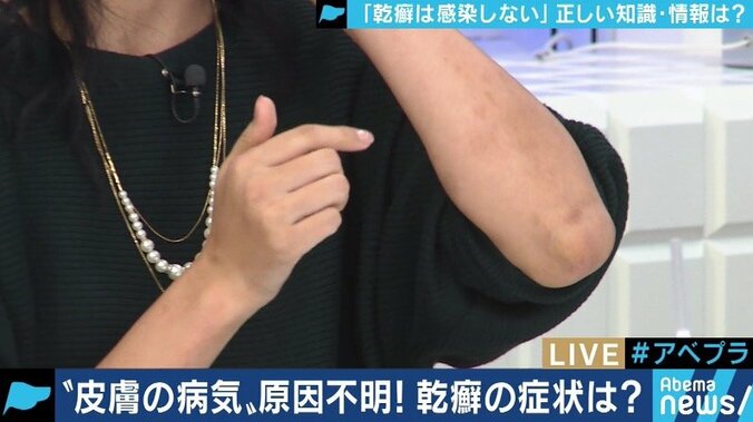 患者が告白「結婚は難しいと言われショックを受けた」　道端アンジェリカも誤解と偏見に苦しむ「乾癬」とは 11枚目