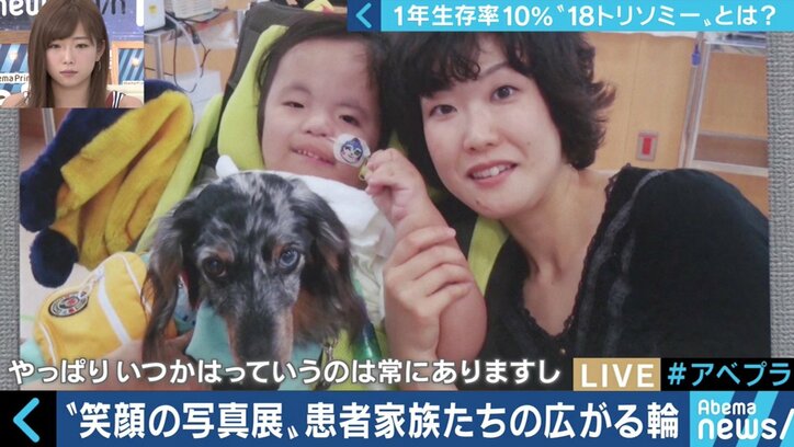 “1年以上の生存率は10％”…18トリソミー児の家族たちが写真展に託した苦悩と葛藤