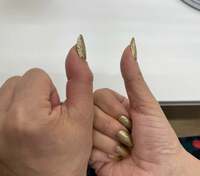 ハイヒールモモコ『腫れてきた親指』