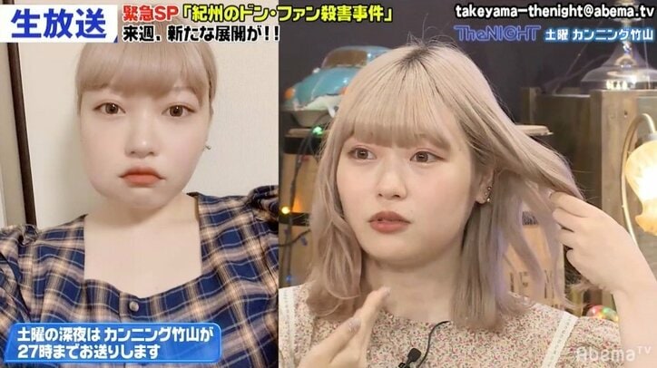 親知らず抜歯後の腫れに竹山戦慄「え? こんな腫れるの!?」