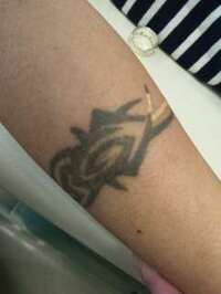 梶田尚美『タトゥー除去レーザー』