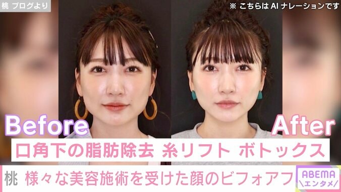 “3度の二重施術”桃、目元の美容施術のビフォーアフターを公開 4枚目
