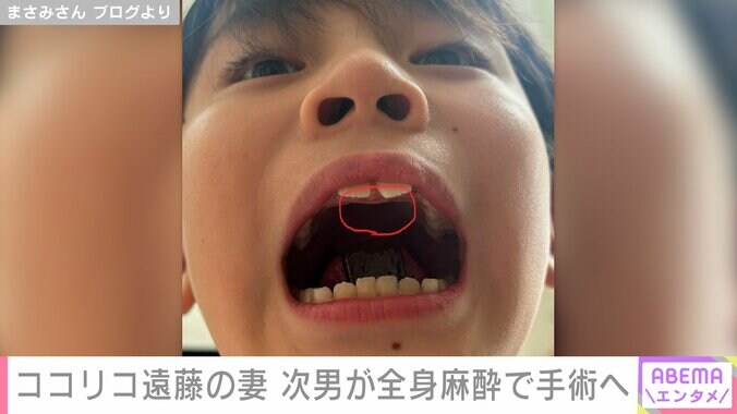 次男・歌楽くんの過剰歯