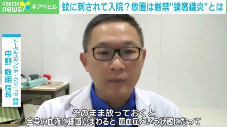 【写真・画像】蚊に刺されて入院? 放置厳禁の「蜂窩織炎」とは? 転倒・靴ずれ・クラゲもきっかけに 2枚目