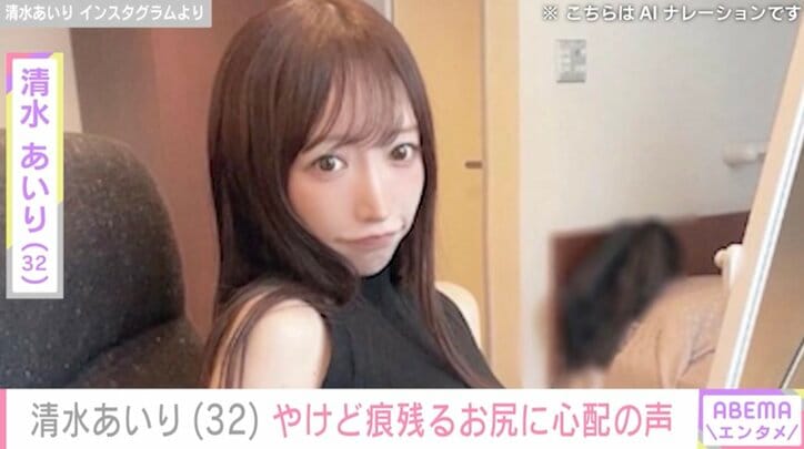 【写真・画像】グラビアアイドル・清水あいり（32）、お尻のやけどを報告「かなり痛そう やけど大丈夫なんですか？」　1枚目