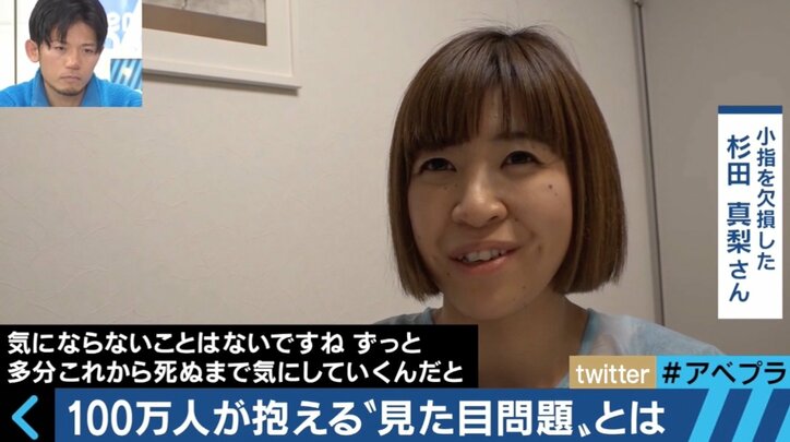 実は100万人が抱える“見た目問題” 当事者たちの生きづらさとは