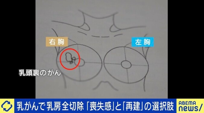 乳がんで全切除した当事者に聞く葛藤