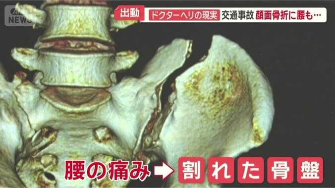 骨盤も大きく2つに