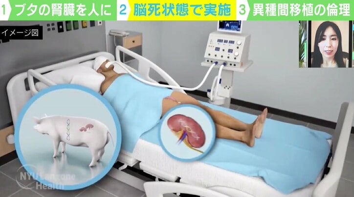 ブタからヒトへ“腎臓移植”米チームが成功 脳死状態で実施も…生命倫理に問題は?