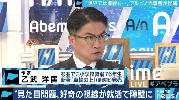 生まれつき色素が薄いアルビノ当事者の苦しみ「カラーコードに合わないから‥」バイト・就職を断られるケースも
