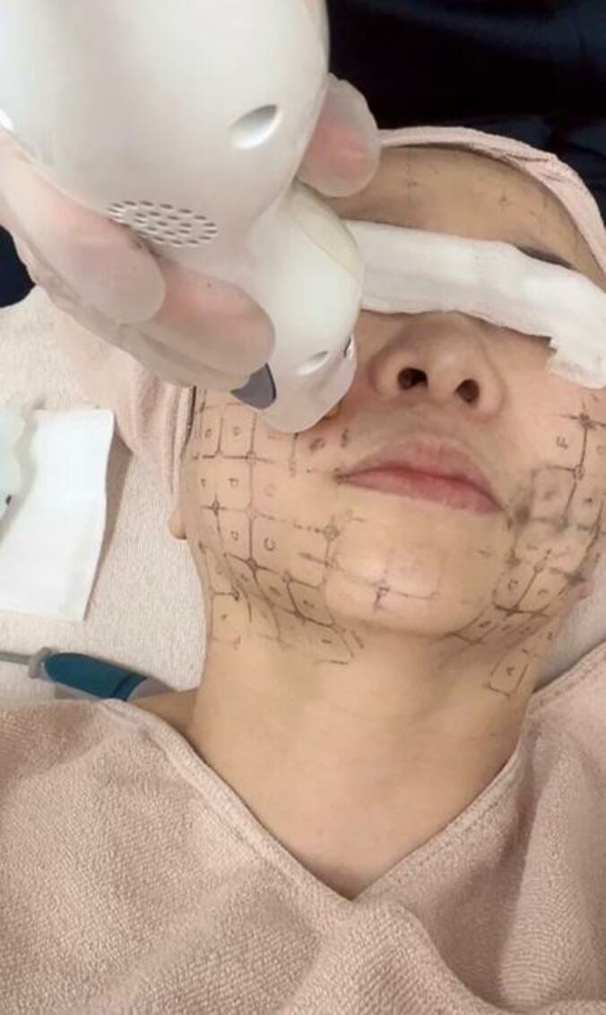  ハイヒール・モモコ、2週間に1回受けている施術「若く見えるからね」  1枚目