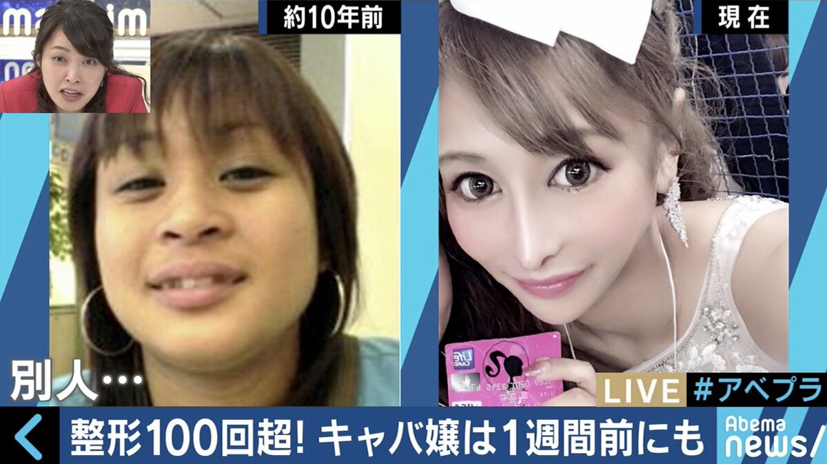 100回以上の整形手術を繰り返した歌舞伎町キャバ嬢の告白 メイク感覚 Sns社会が生んだ 整形依存 国内 Abema Times