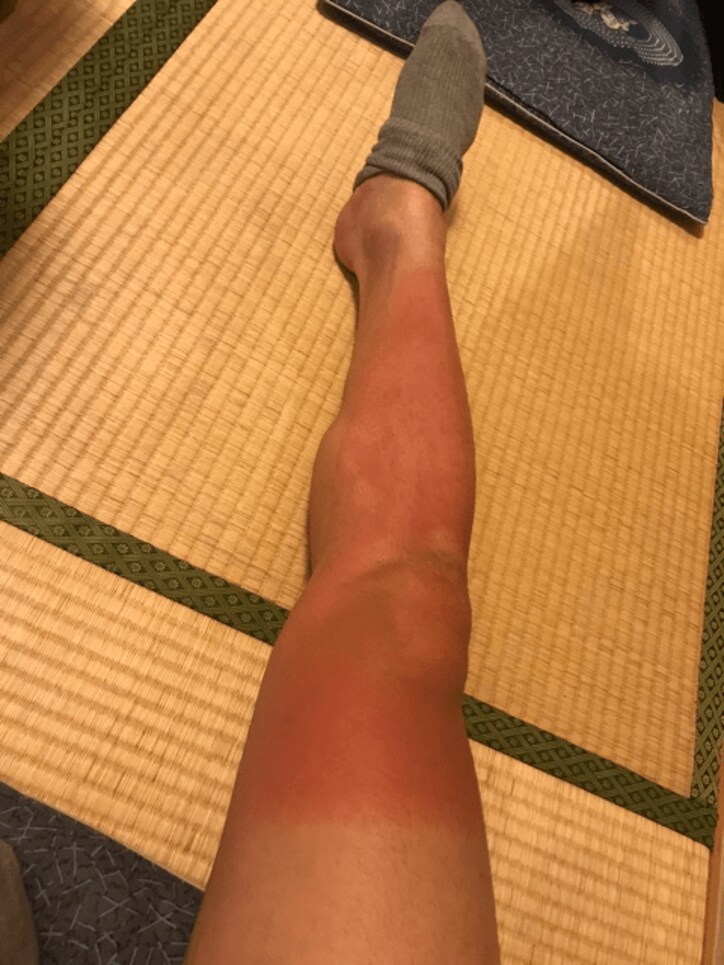 横山だいすけ、日焼けした生足披露にファンから心配の声&悶絶の声殺到「鼻血出そう」