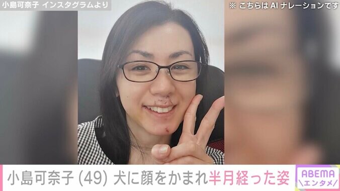 【写真・画像】犬に顔をかまれ約30針縫った小島可奈子、半月経った姿を公開「やけどより5倍深い傷なので残りますときっぱり言われまして」　2枚目