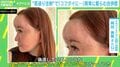 “若返り注射”でおでこが膨らみ「コブダイ」に!? 当事者「よくこれで生きてたな。額の限界を感じた…」 PRP+bFGFとは?