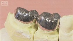 「銀歯治療するほど赤字」　貴金属高騰で歯医者ピンチ　1本あたり3000円自腹