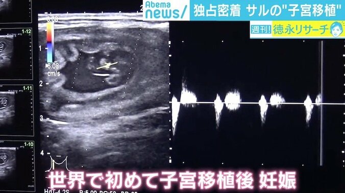 “子宮移植後”のサルで初の妊娠に成功、最新医療から見えた不妊治療の可能性と課題 5枚目