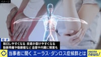 「エーラス・ダンロス症候群」とは？ 症状と課題を当事者に聞く
