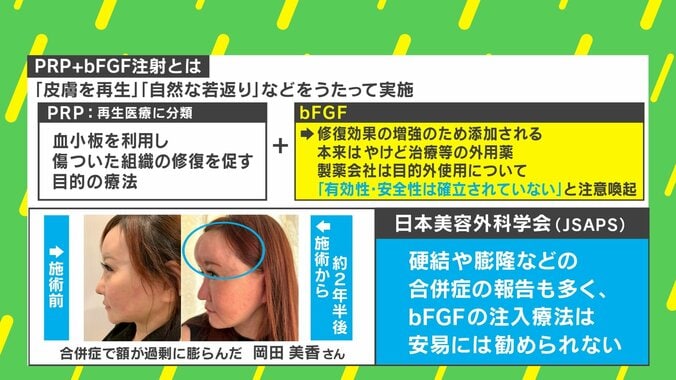 【写真・画像】“若返り注射”でおでこが膨らみ「コブダイ」に！？ 当事者「よくこれで生きてたな。額の限界を感じた…」 PRP＋bFGFとは？　3枚目