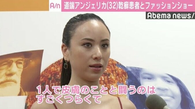 道端アンジェリカ、“乾癬”告白の理由は「ただ悔しかった」 3枚目