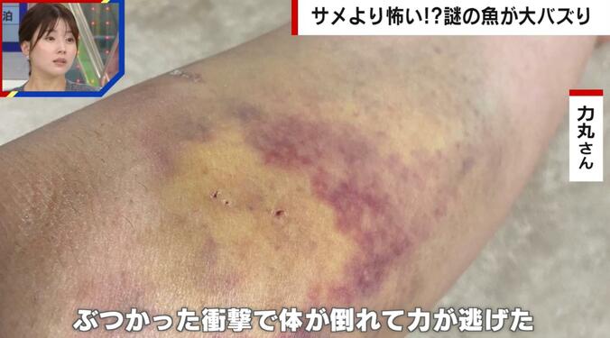 ゴマモンガラに襲われた女性の症状