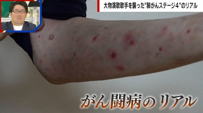 副作用に苦しむ山川豊