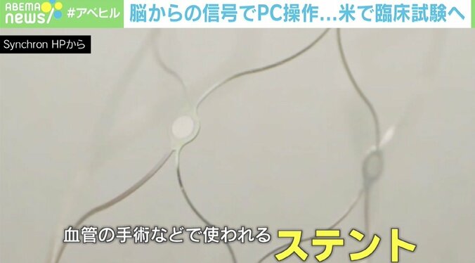 脳の信号でPC操作 米の臨床実験に専門家「ゼロが1になる」「ALS患者にとって大きな一歩だ」 3枚目
