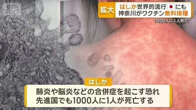 肺炎や脳炎などの合併症を起こす「はしか」