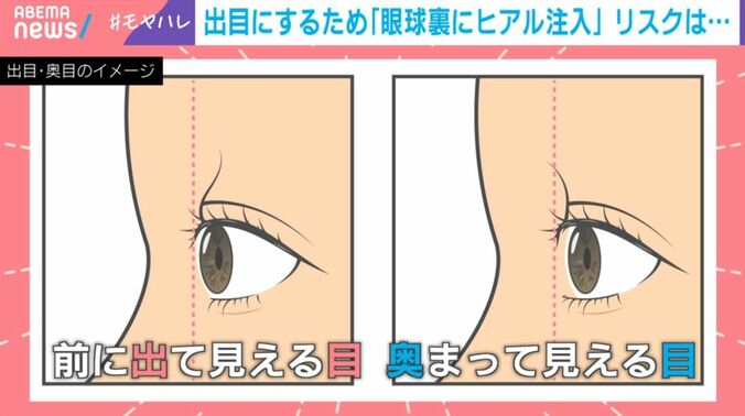 「出目」「奥目」のイメージ