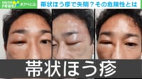 帯状疱疹で失明？ 疲れとストレスがトリガーに