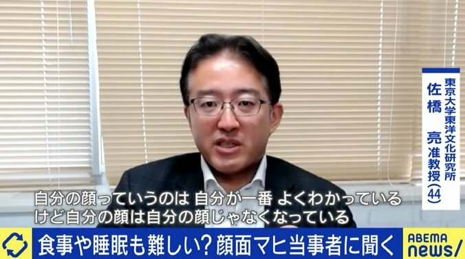 「自分の顔が自分の顔じゃなくなってしまう感じが残った」ジャスティン・ビーバーも罹患した“ラムゼイ・ハント症候群”、発症のピークは20代と50代に 2枚目