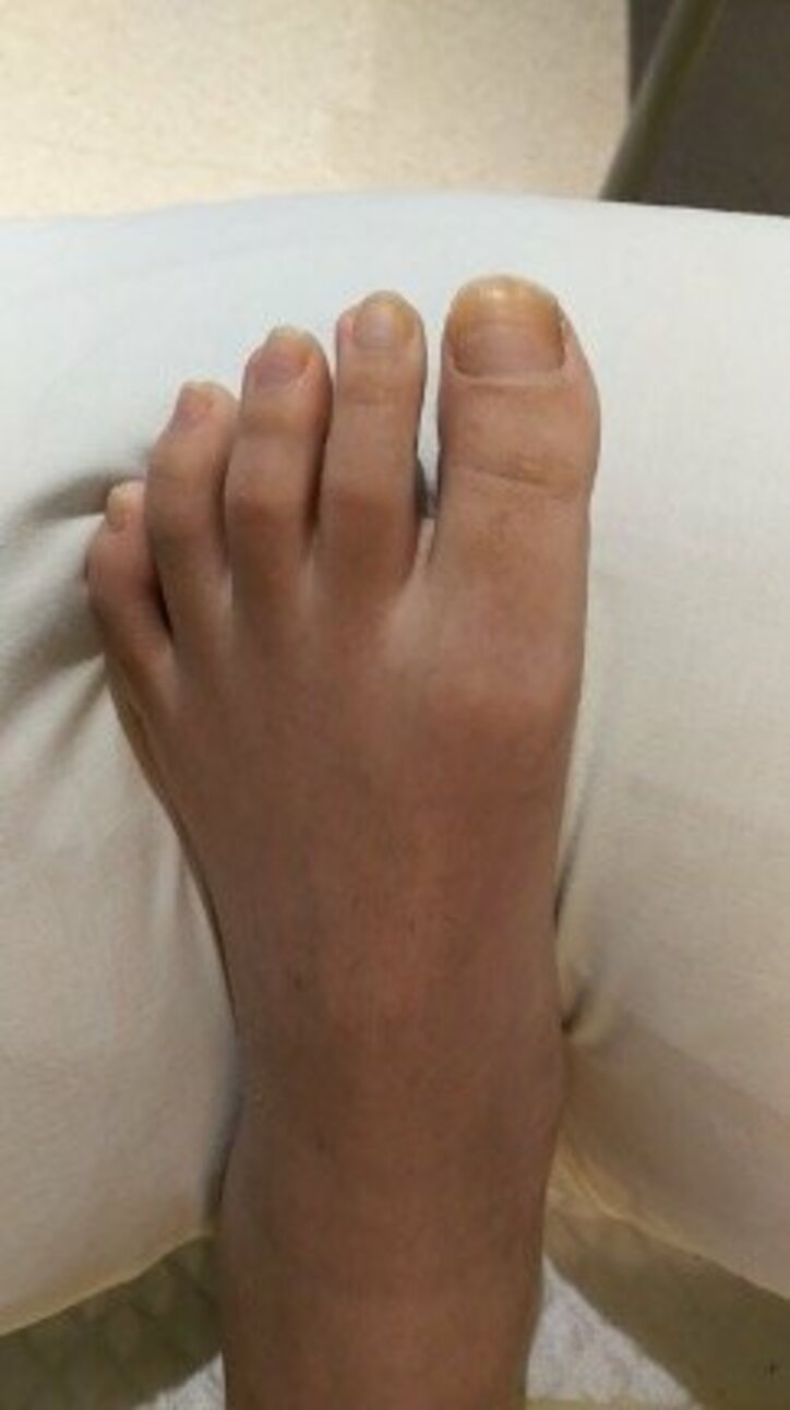 脊髄損傷でリハビリ中の滝川英治 足の指が微かに動き 信じよう奇跡 話題 Abema Times