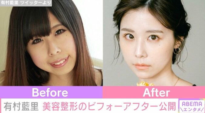 有村藍里、美容整形のビフォーアフター公開「私は整形や歯列矯正したのもそうなんだけれど」“垢抜け”への持論を展開 1枚目