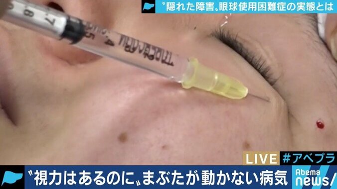 「目が開かない」「動く光で激痛」ドライアイ患者の中にも”予備軍”？眼科医も知らない「眼球使用困難症」 5枚目