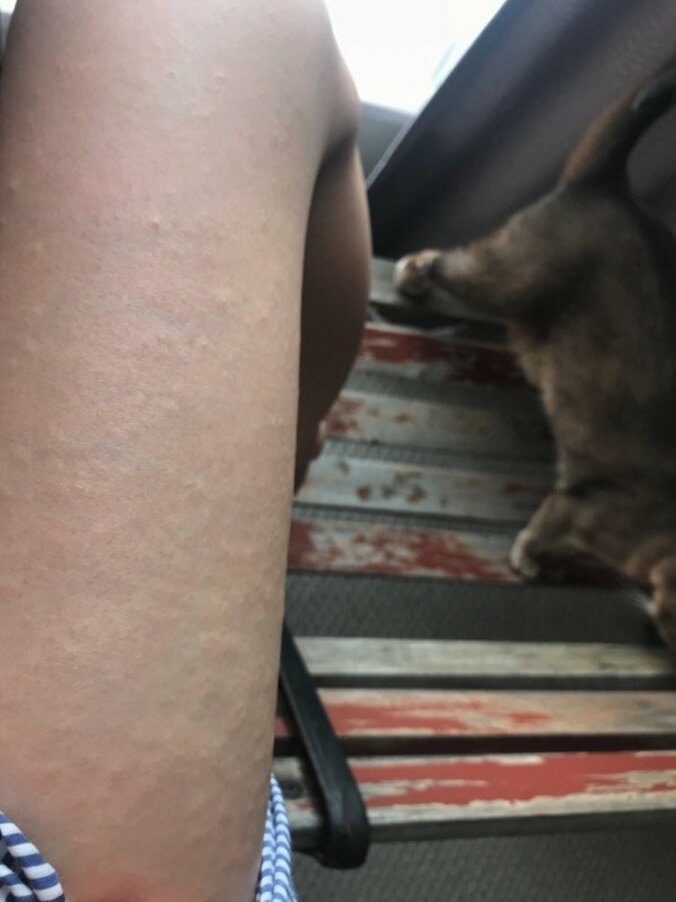 あいのり・桃、原因不明の蕁麻疹が発症　異常なかゆみを訴える「なんだろこれ…かゆいよー」 2枚目