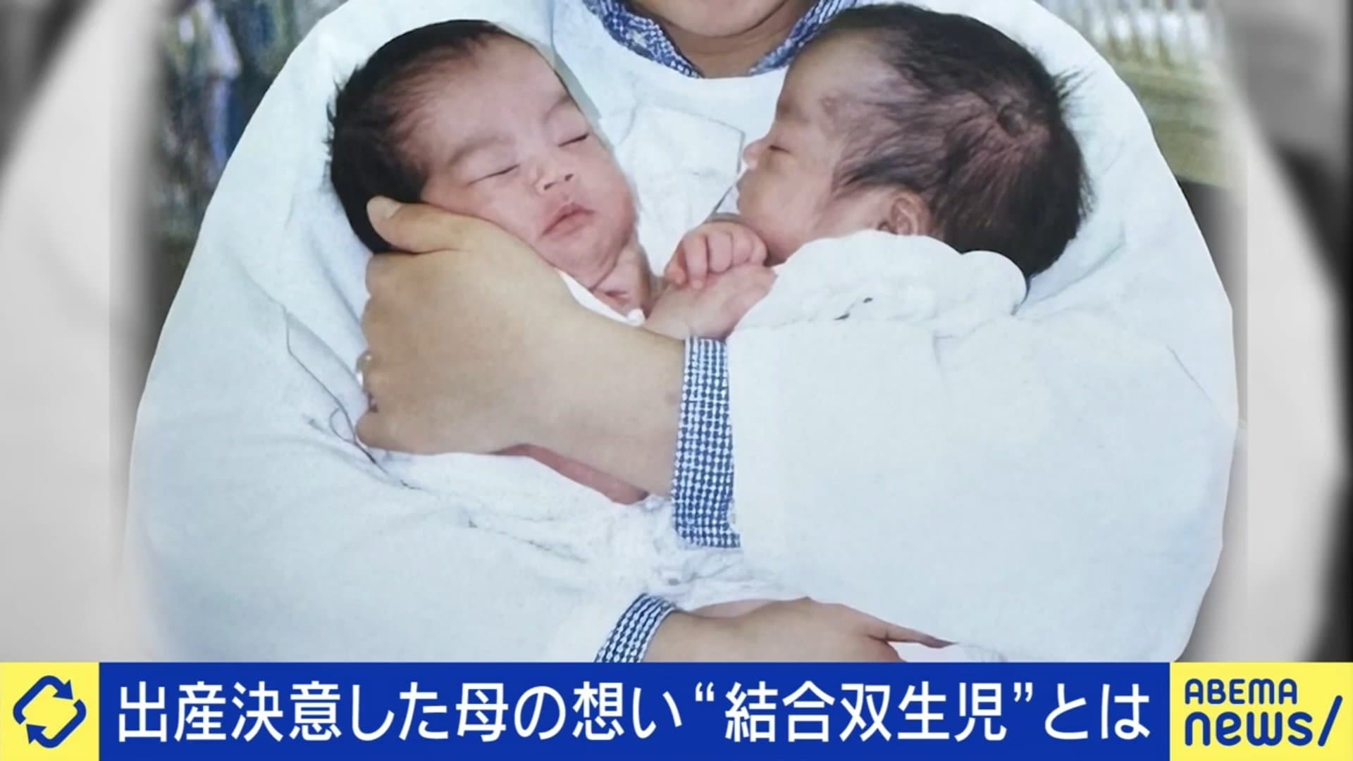(2ページ目) 「いつ中絶をしますか?」20万人に1人“結合双生児”を宿した母が医師から告げられた言葉「くっついていてもいいやと思った」覚悟が ...