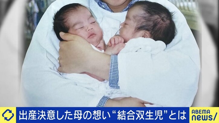 結合双生児
