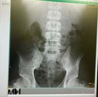 ネイボール(Neyball)『#2 白血病と診断されるまで①』